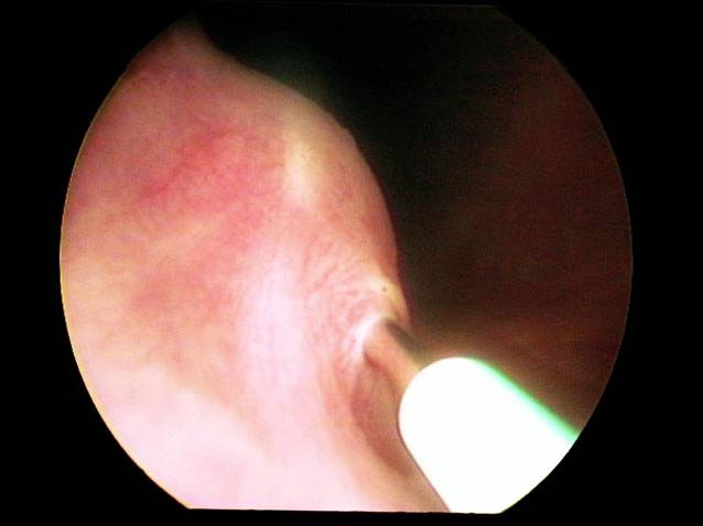 urinary-incontinence-fig3