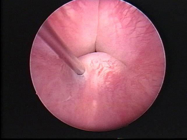 urinary-incontinence-fig4